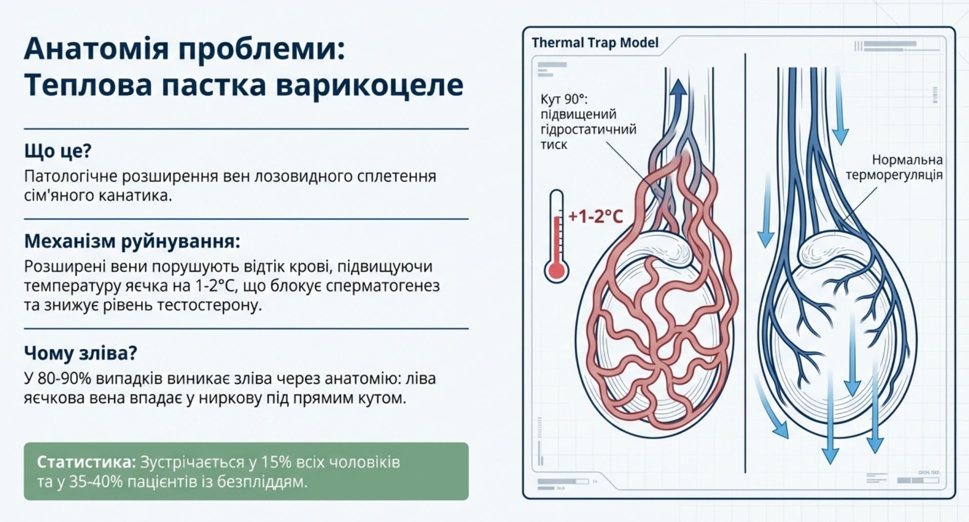 Схема варикоцеле: розширені вени сім'яного канатика і порушення венозного відтоку від яєчка
