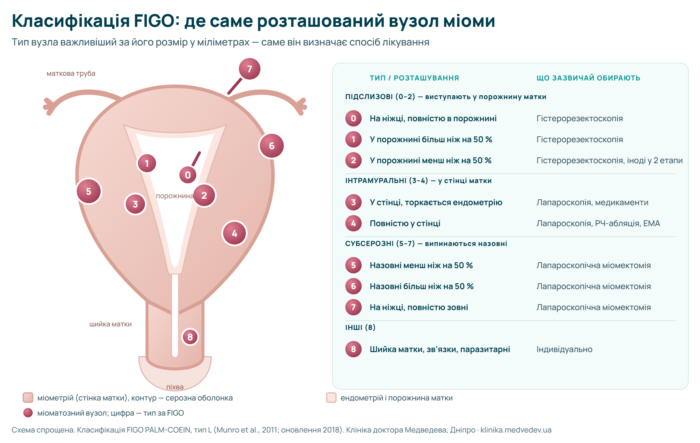 Схема класифікації FIGO міоми матки: типи 0–8 і який метод лікування зазвичай обирають для кожного