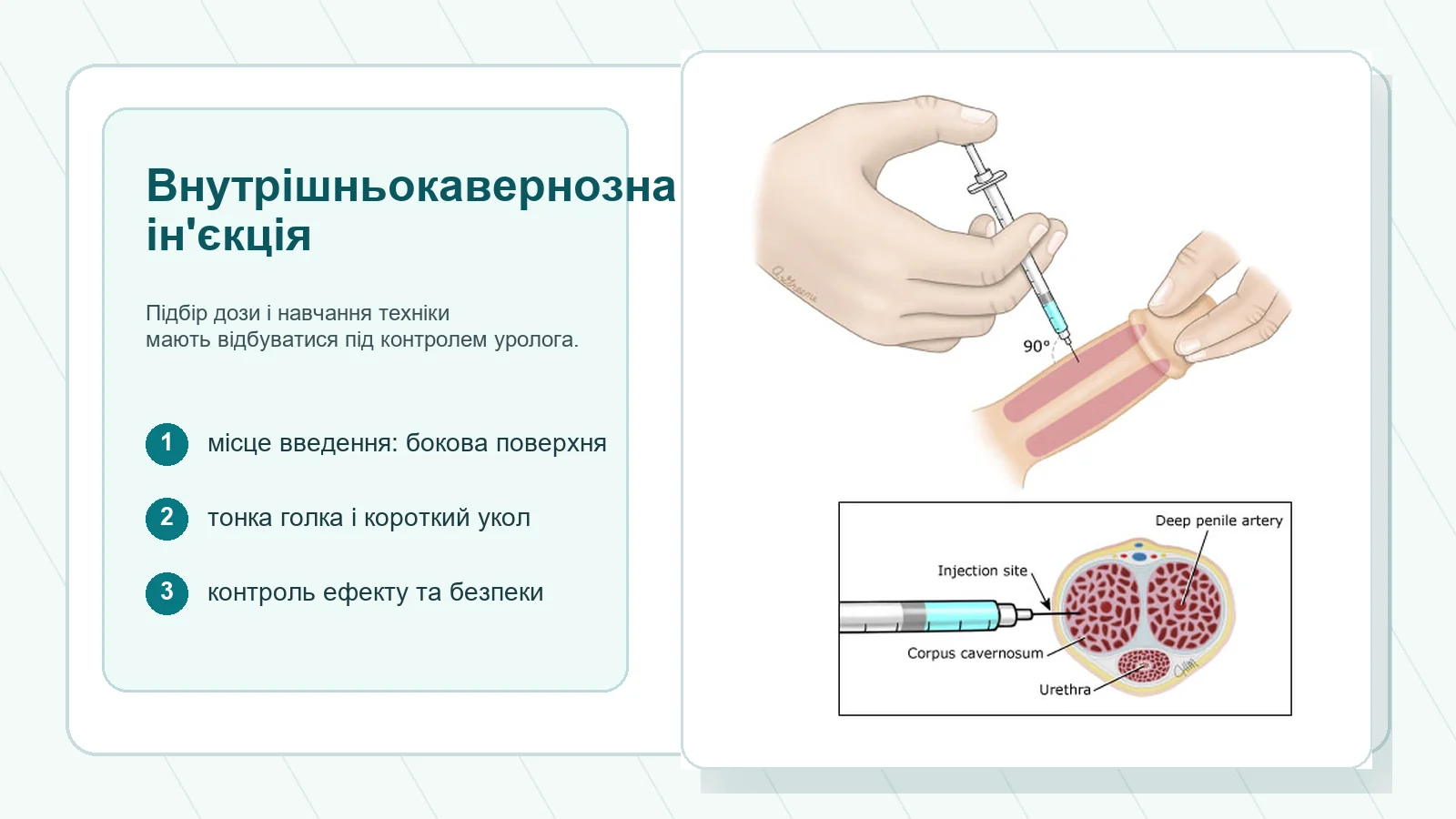 Схематичне зображення місця внутрішньокавернозної ін'єкції та кавернозних тіл статевого члена