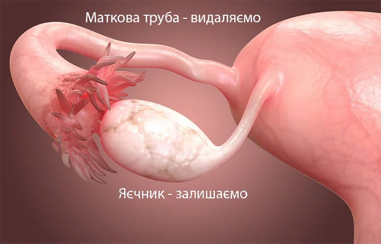 Яєчник і маткова труба як зона, яку лікар окремо оцінює під час планування гістеректомії