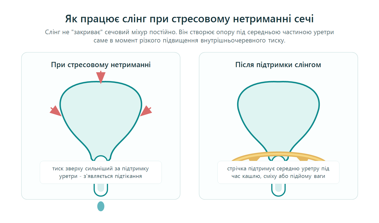 Схема: як слінг підтримує середню уретру при стресовому нетриманні сечі