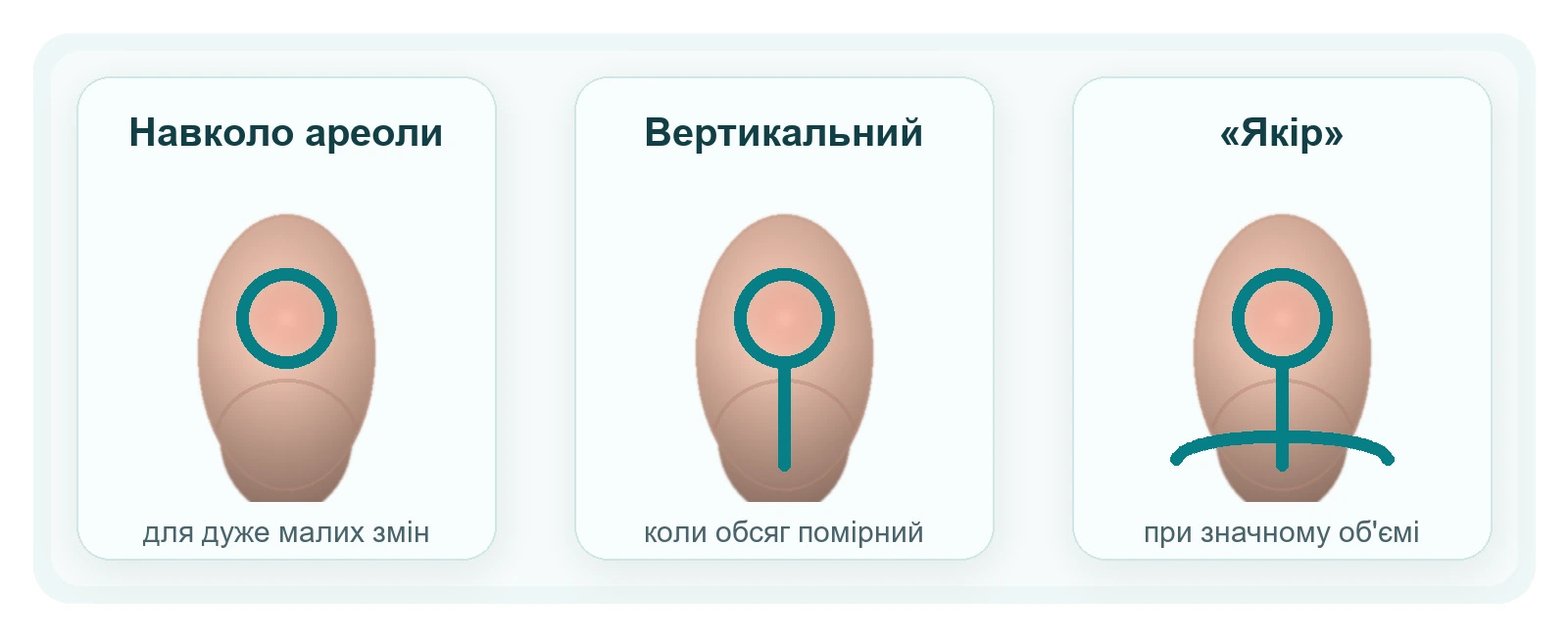 Реалістична медична схема трьох варіантів розрізів при редукційній мамопластиці: навколо ареоли, вертикальний та якір