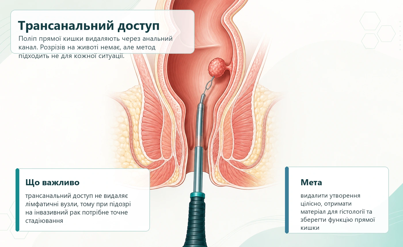 Схема трансанального доступу до поліпа прямої кишки без розрізів на животі