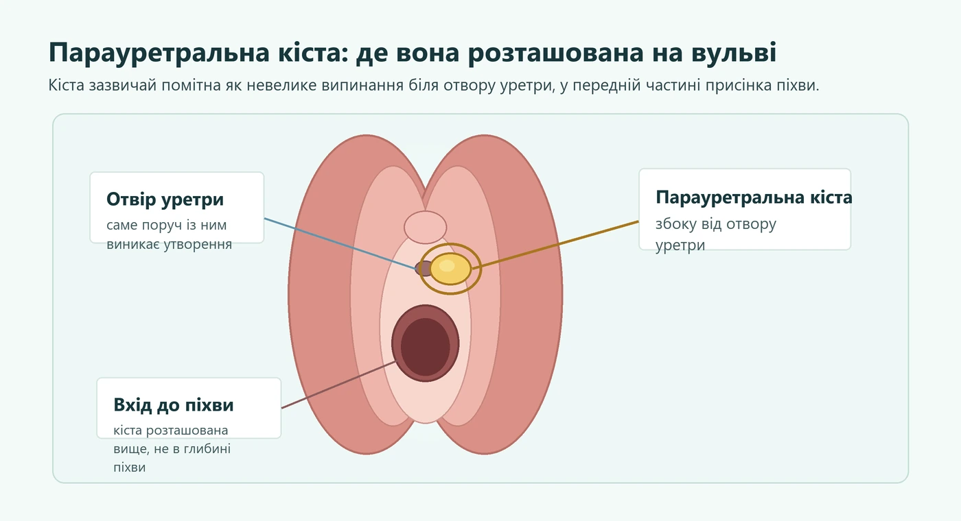 Схема зовнішньої вульви з позначенням парауретральної кісти біля отвору уретри
