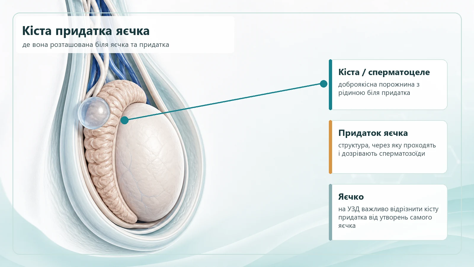 Схема розташування кісти придатка яєчка біля яєчка та придатка